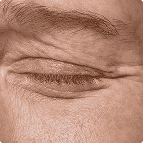 Fine Lines &Early Aging